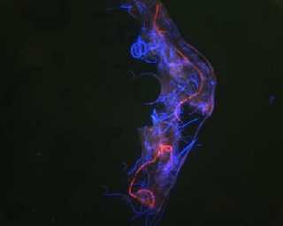 Fluoreszierende Morgellonsfasern unter UV-Licht. Bildquelle mit n�herer Beschreibung www.morgellons.org/symptoms.htm